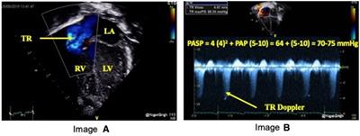 A scoping review of echocardiographic and lung ultrasound biomarkers of bronchopulmonary dysplasia in preterm infants